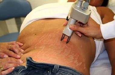 Stretch Mark Treatment with Laser