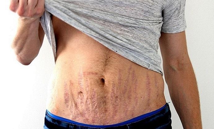 Stretch Marks in Men: How to Treat Them and What to do