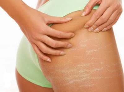 How to Treat Stretch Marks on the Inner Thighs During Pregnancy